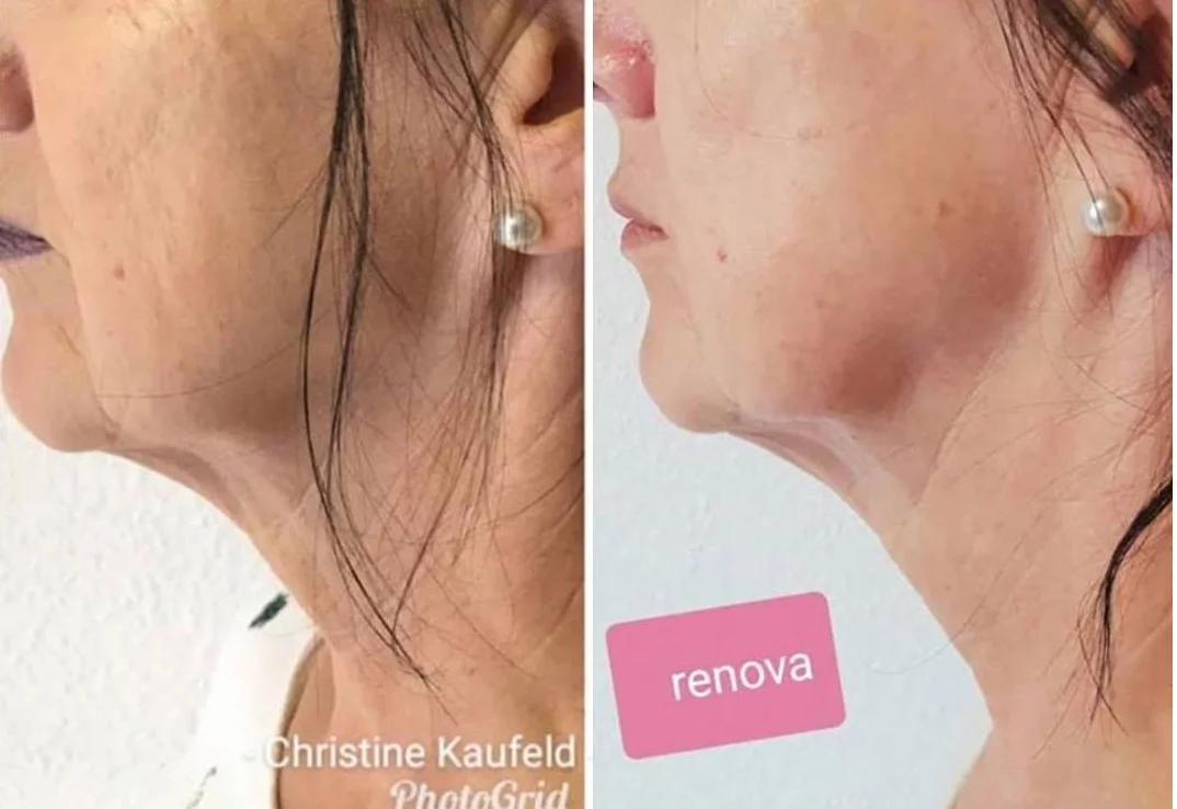 【極美品】Non-Surgical Skin Tightening and Li RenewaLift™ Non-Invasive Skin Tightening MicroCurrent & LED